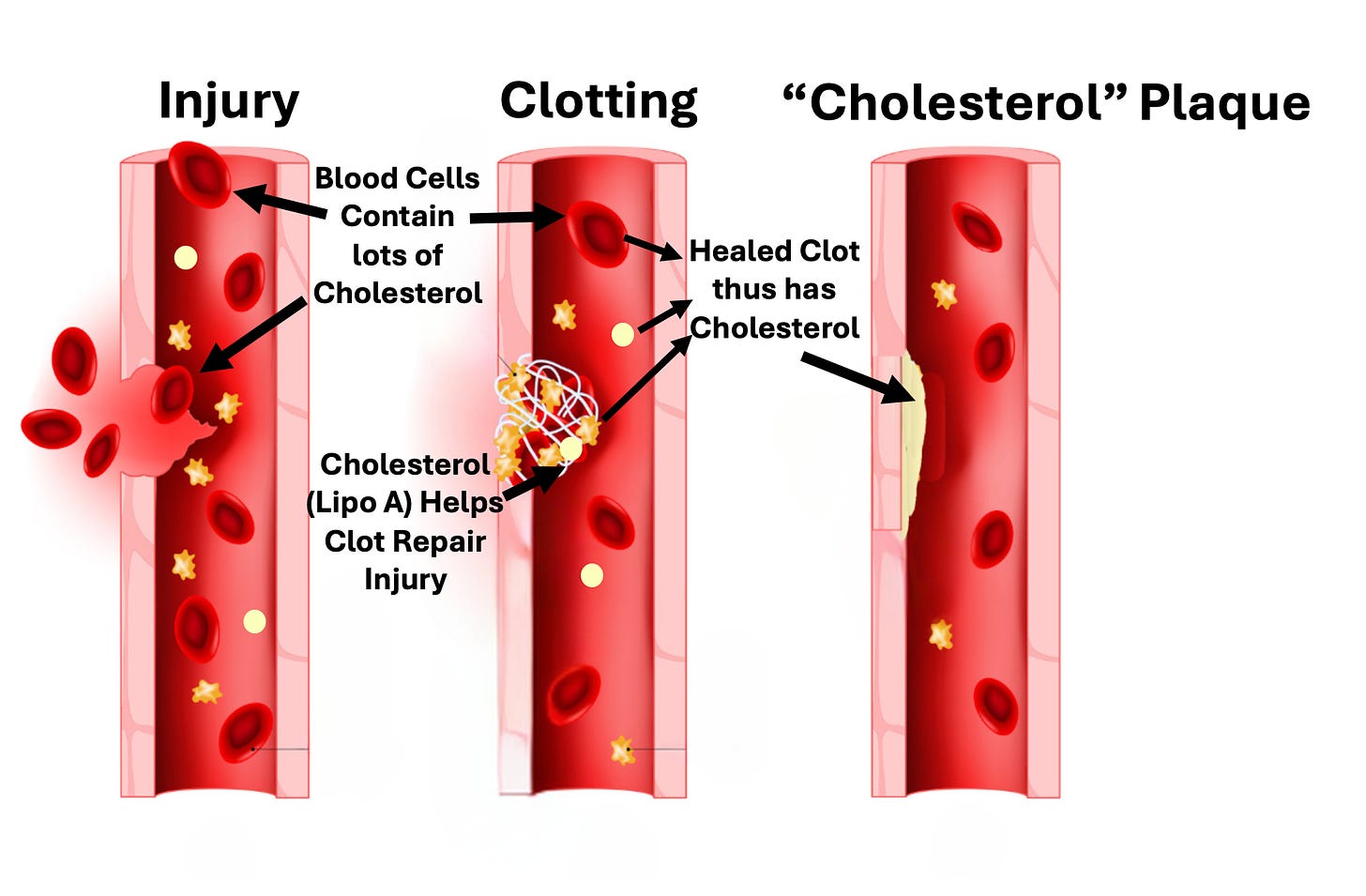 A diagram of cholesterol and clotting

Description automatically generated